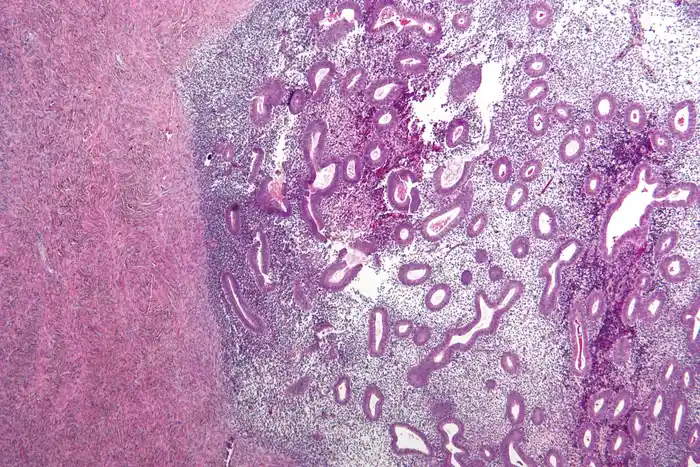 Micrografia de endometriose do ovário